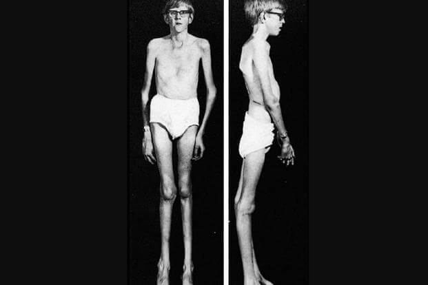 A man with Marfan Syndrome. (Merck)
